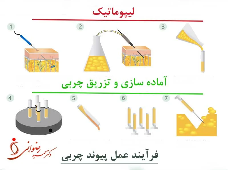 Fat transfer operation