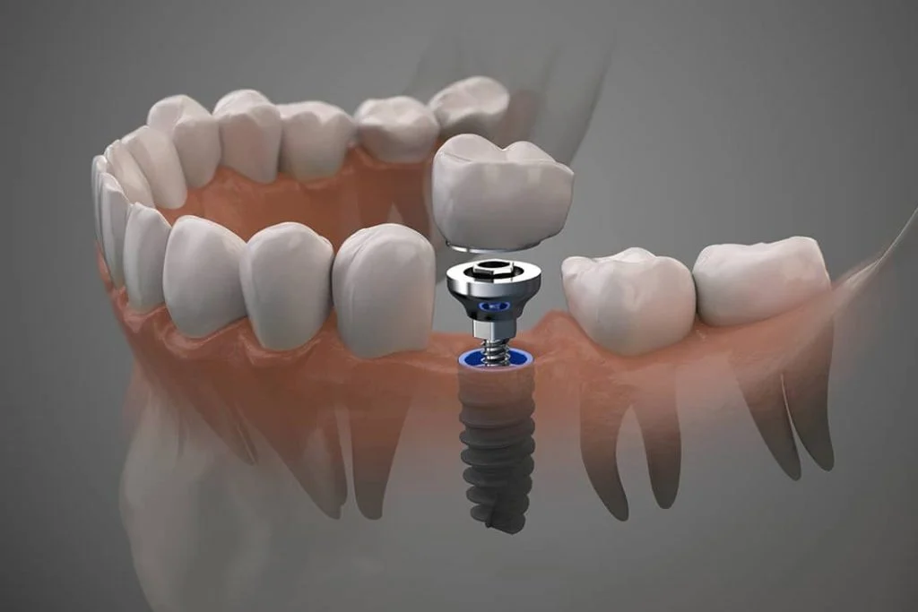 The cause of bad breath after implant
