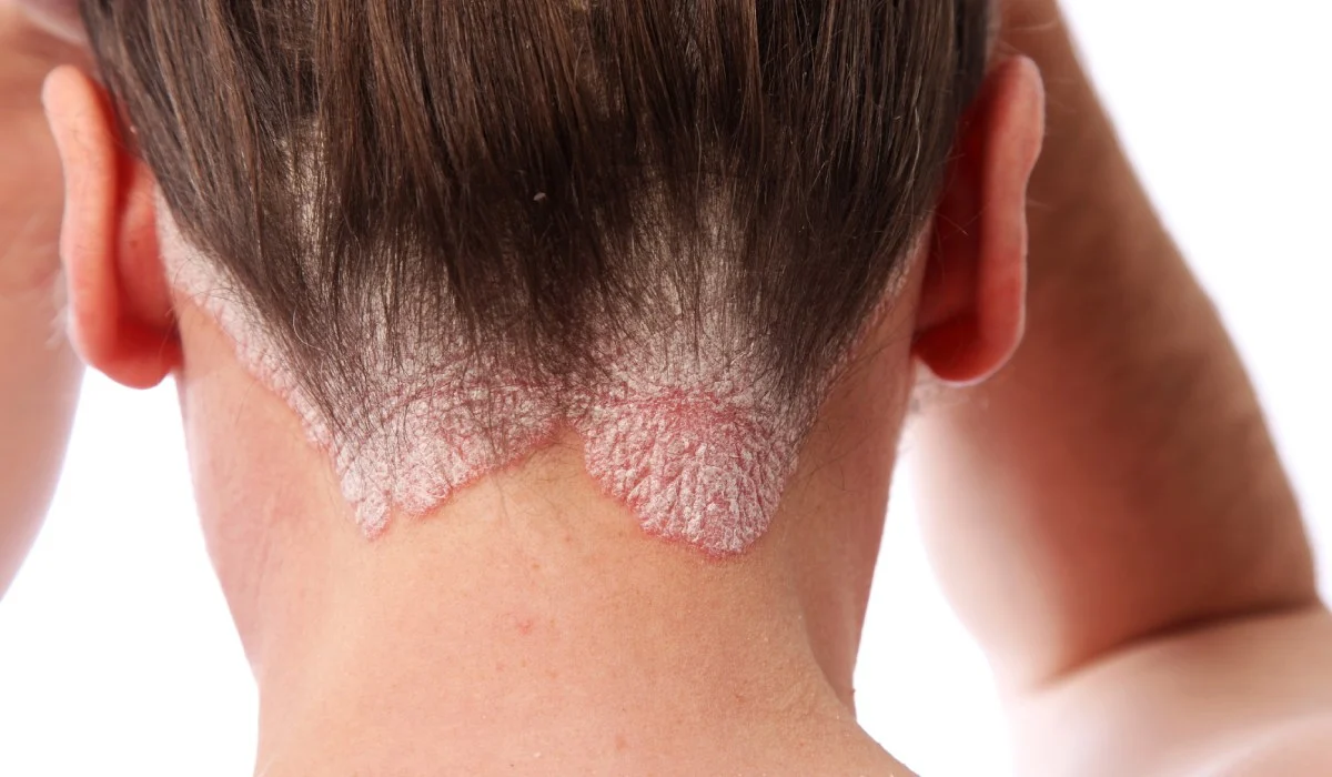 What is psoriasis?