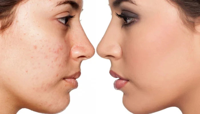 The scrub removes blackheads