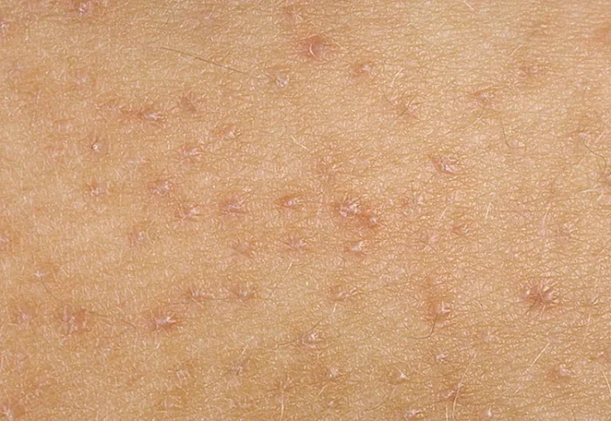 علائم اولیه گال: چگونه این بیماری را در مراحل ابتدایی تشخیص دهیم؟