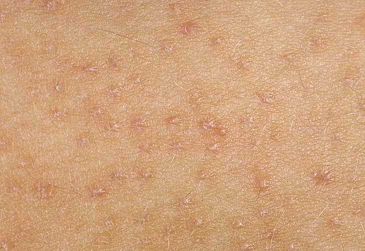 علائم اولیه گال: چگونه این بیماری را در مراحل ابتدایی تشخیص دهیم؟