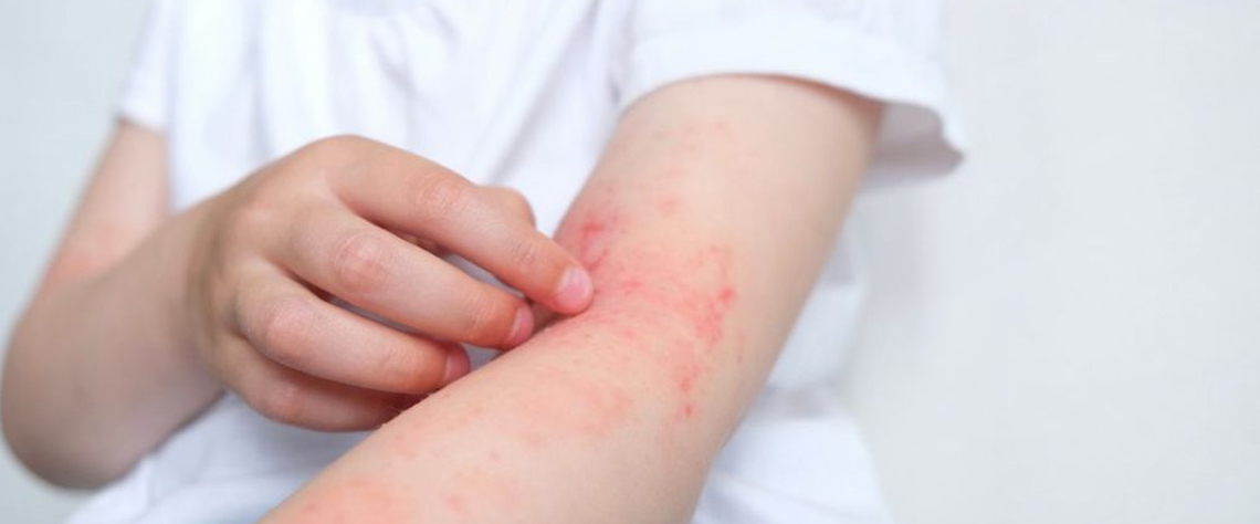 چرا کرم ضد قرمزی سیلکر انتخاب اول متخصصان پوست است؟